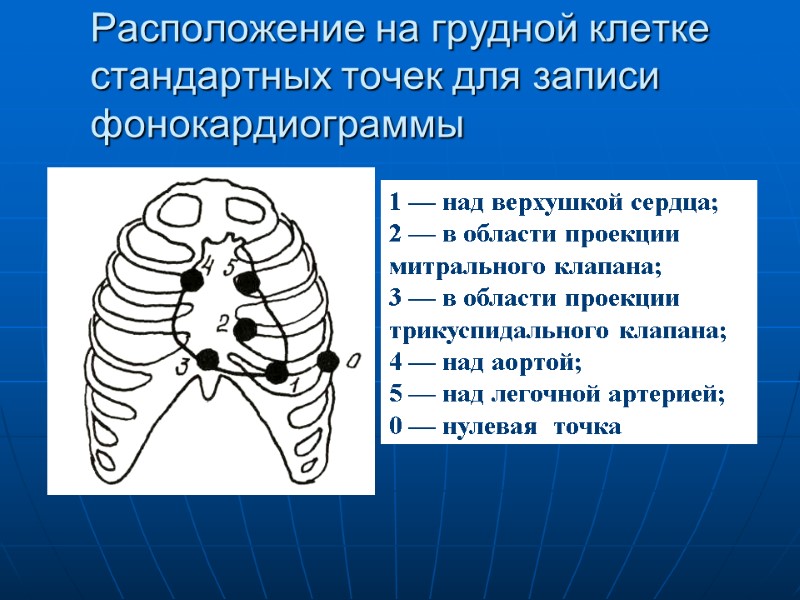 Расположение на грудной клетке стандартных точек для записи фонокардиограммы 1 — над верхушкой сердца; Расположение на грудной клетке стандартных точек для записи фонокардиограммы 1 — над верхушкой сердца;